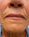 Fraxel Re:pair for Skin Rejuvenation