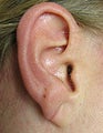 Split Earlobe