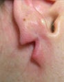 Split Earlobe