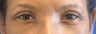 Upper Blepharoplasty