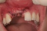 Implant and Cantileeverd Bridge