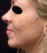 Revison Rhinoplasty