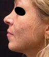 Revison Rhinoplasty