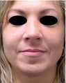 Revision Rhinoplasty