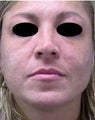 Revision Rhinoplasty