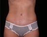 Tummy tuck