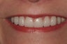 Veneers and Invisalign