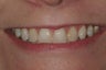 Veneers and Invisalign
