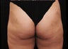 Liposuction Lateral Thigh PAL