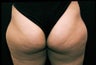 Liposuction Lateral Thigh PAL