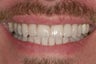 Porcelain Veneers