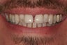 Porcelain Veneers