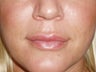 Lip Implants
