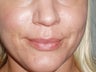 Lip Implants