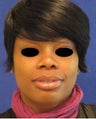 Rhinoplasty