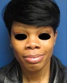 Rhinoplasty