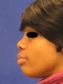 Rhinoplasty