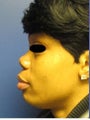 Rhinoplasty