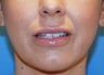 Lip Augmentation
