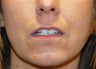 Lip Augmentation