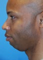 Chin implant