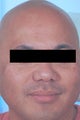Asian Skin Freckle Removal