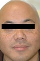 Asian Skin Freckle Removal