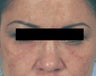 Restylane for eye bags