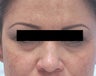 Restylane for eye bags