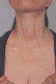 Laser treatment for neck and chest sun damage