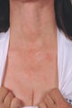 Laser treatment for neck and chest sun damage