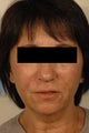 Juvederm for laugh lines
