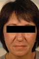 Juvederm for laugh lines