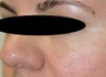 Restylane for eye bags