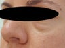 Restylane for eye bags