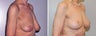 Breast Lift