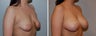 Breast augmentation and lift