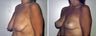 Breast Lift