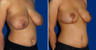 Breast Lift