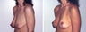 Breast Lift