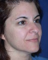 Ulthera treatment face and brow