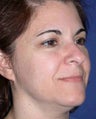 Ulthera treatment face and brow
