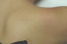Laser Tattoo Removal
