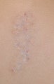 Long Beach Laser Tattoo Removal