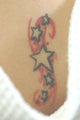 Long Beach Laser Tattoo Removal