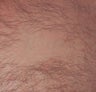 Chest Tattoo Removal - Lasers