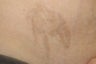 Laser Tattoo Removal Photos