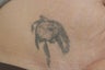 Laser Tattoo Removal Photos
