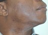 Laser Hair Removal Dark Skin