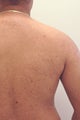 Permanent Back Hair Removal with Lasers